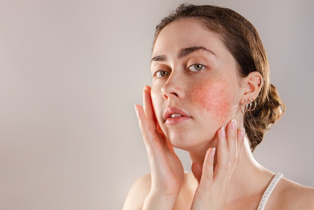 Best Moisturizers For Rosacea - Beauty Tribe