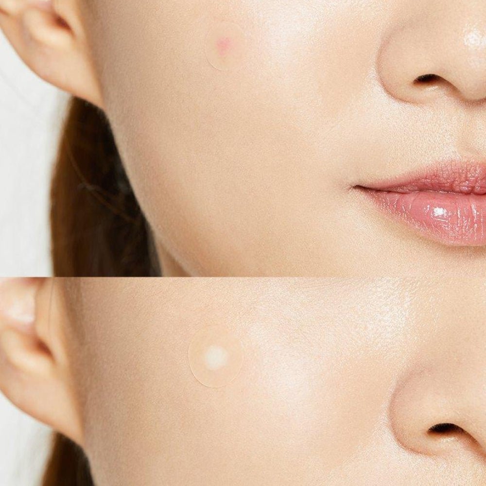COSRX Acne Pimple Patch - 24 Patches - Beauty Tribe