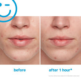 Kate Somerville EradiKate Acne Treatment 1oz - Beauty Tribe