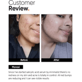 Minimalist 2% Salicylic Acid Serum For Oily Skin 30ml - Beauty Tribe