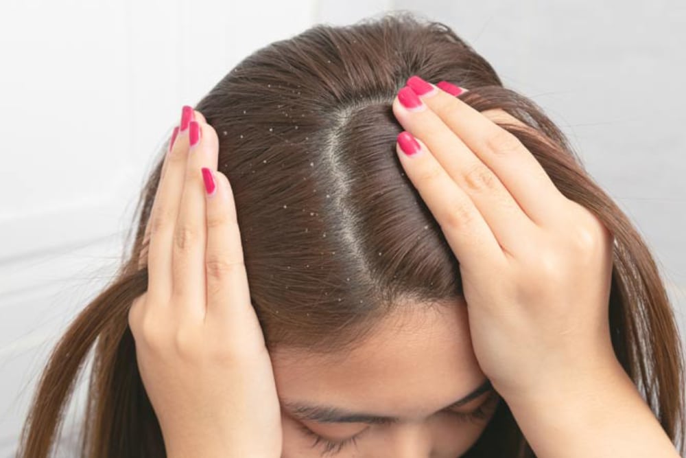 3 Amazing Products to Get Rid of Dandruff Permanently