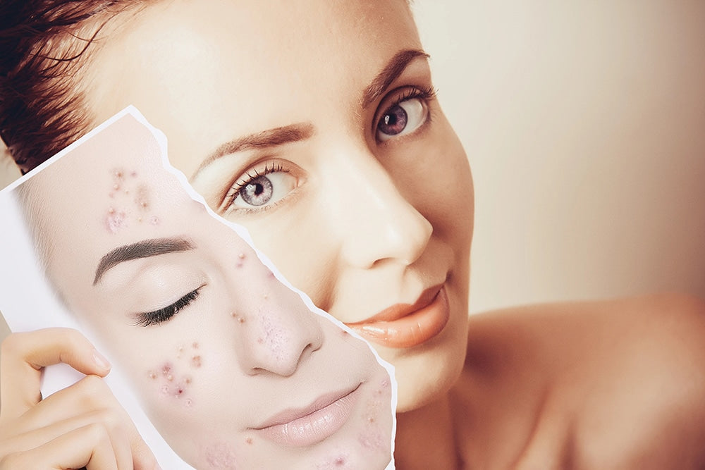 A Guide To Acne Prone Skin Care