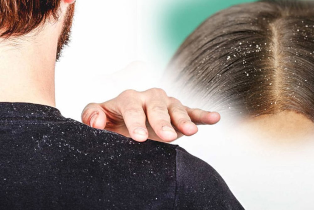 How to Get Rid of Dandruff