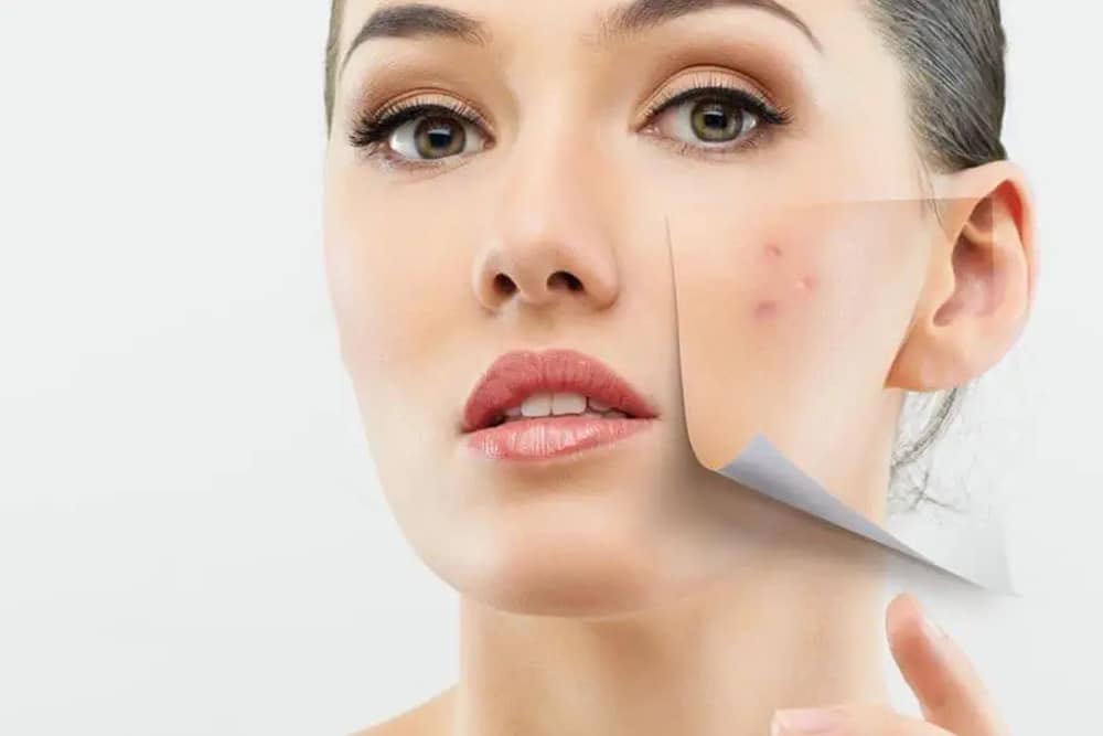 What Products Reduce Pimples