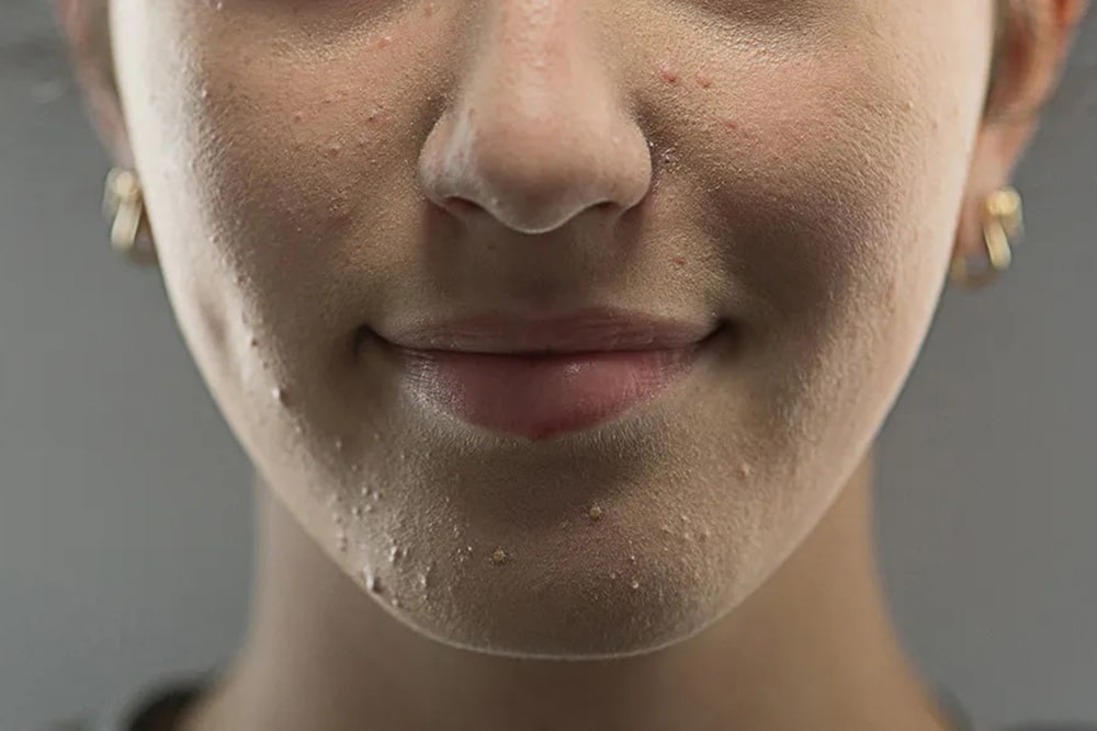 Acne Prone Skin - Tips, Care, And Products - Beauty Tribe