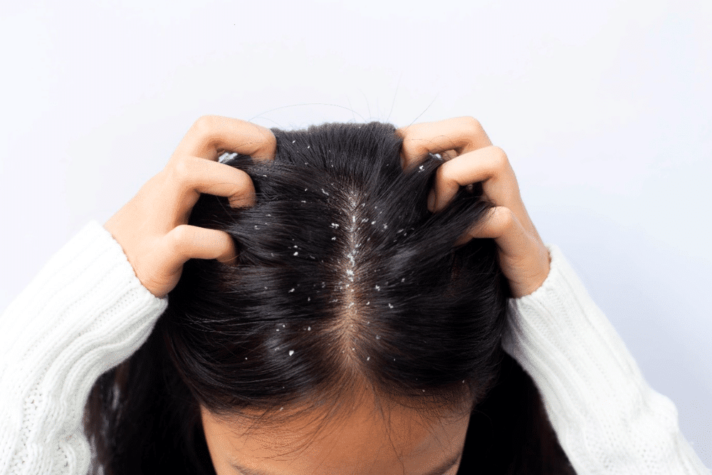 Miracle Products That Get Rid of Dandruff - Beauty Tribe