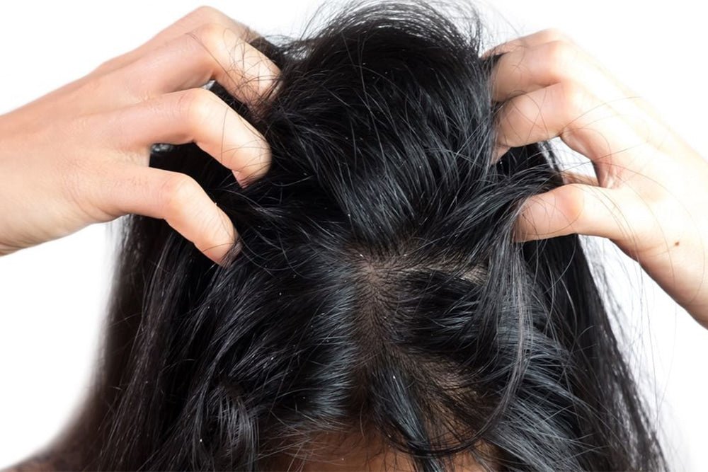 Top 5 Dandruff Solutions That Give Fast Results - Beauty Tribe