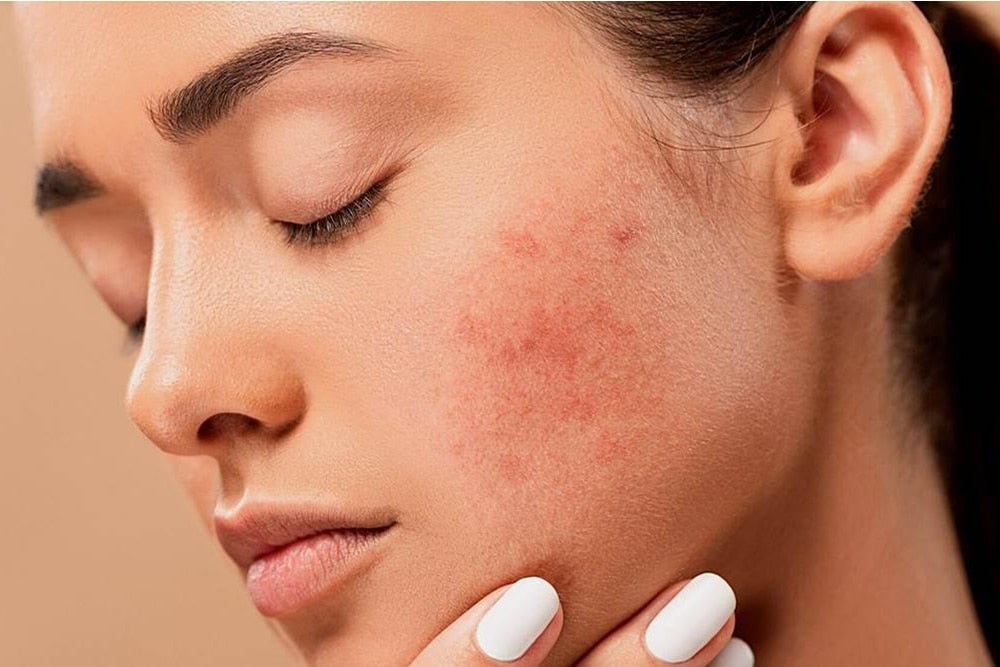 What Are The Best Products For Acne? - Beauty Tribe