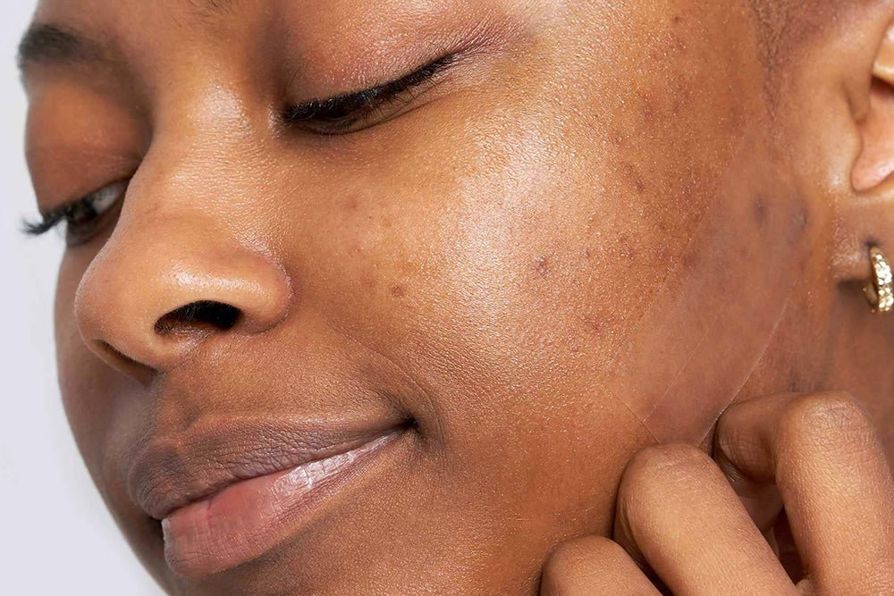 What Are The Best Products For Acne Scars? - Beauty Tribe