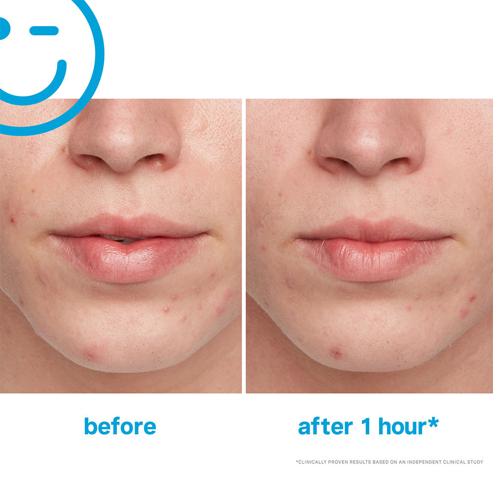 Kate Somerville EradiKate Acne Treatment 1oz