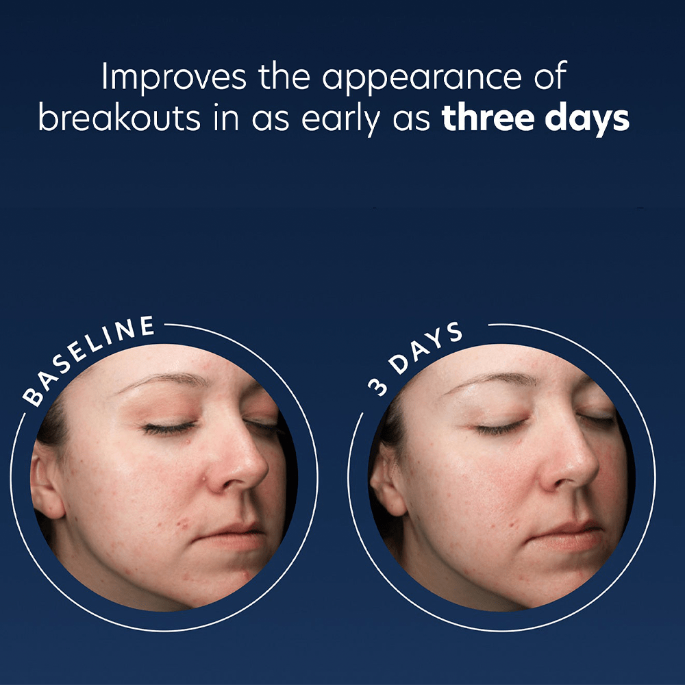 PCA Acne Gel with OmniSome® 29.5ml - Beauty Tribe