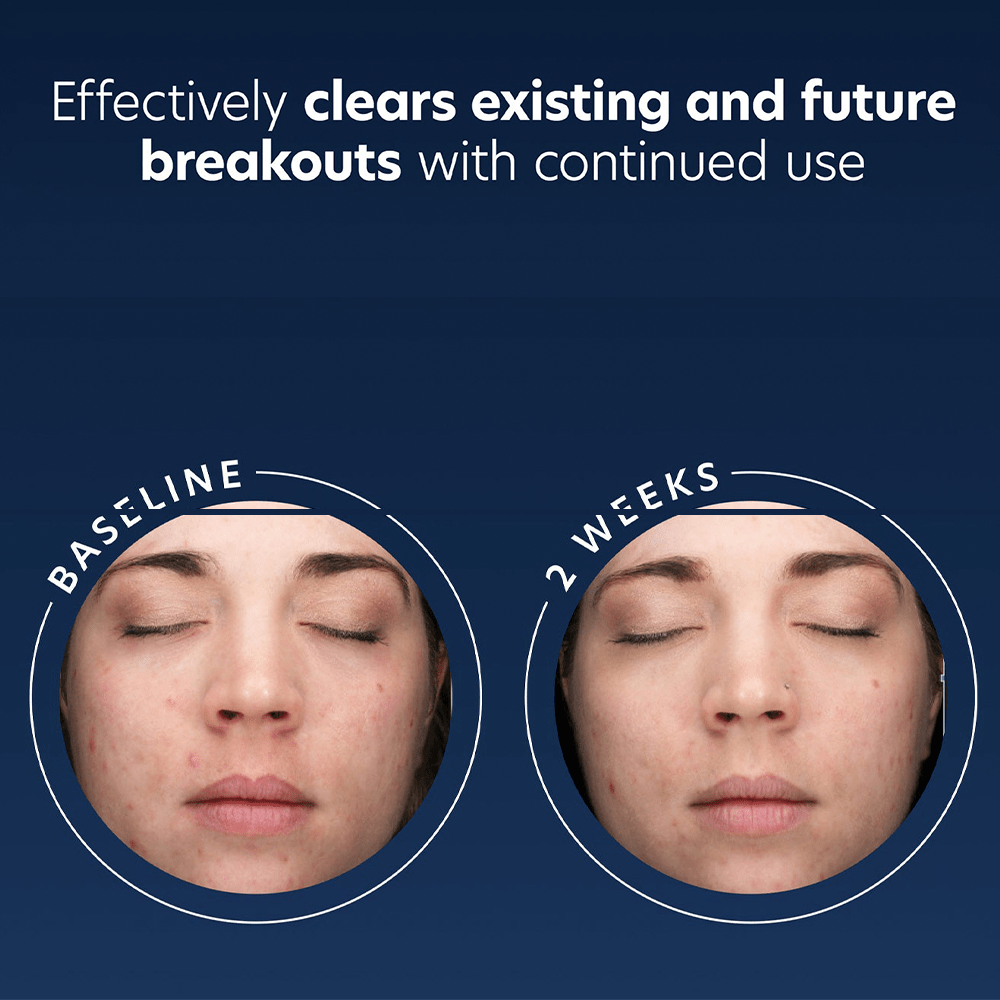 PCA Acne Gel with OmniSome® 29.5ml - Beauty Tribe