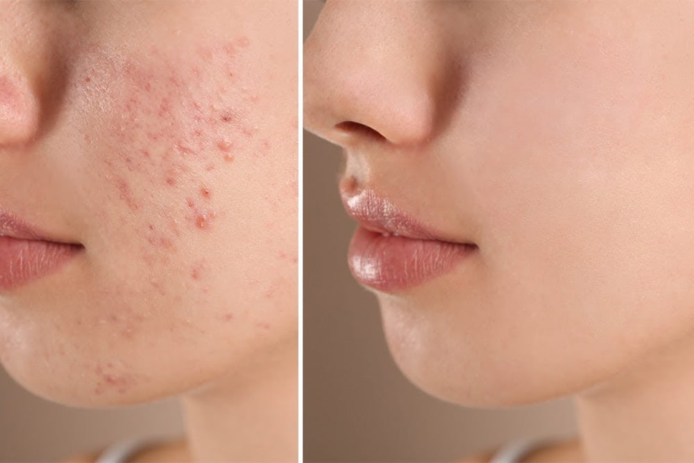 Get Rid Of Acne With These 3 Products