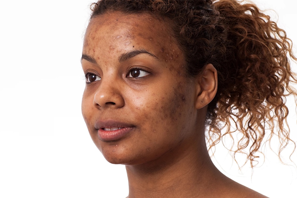 What Are The Best Products For Hyperpigmentation