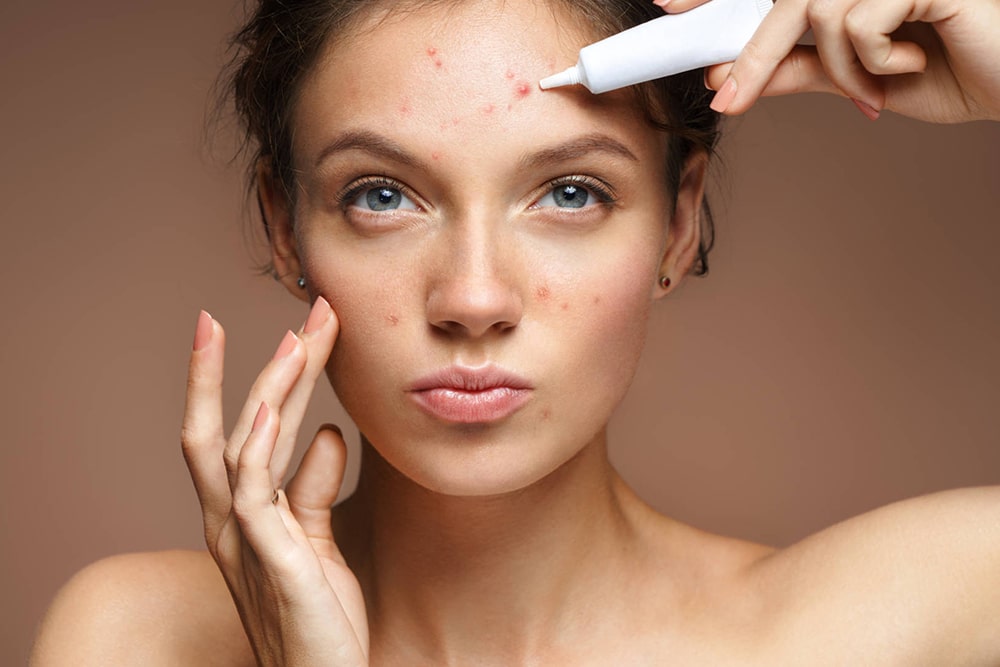 Products For Treating Acne Prone Skin
