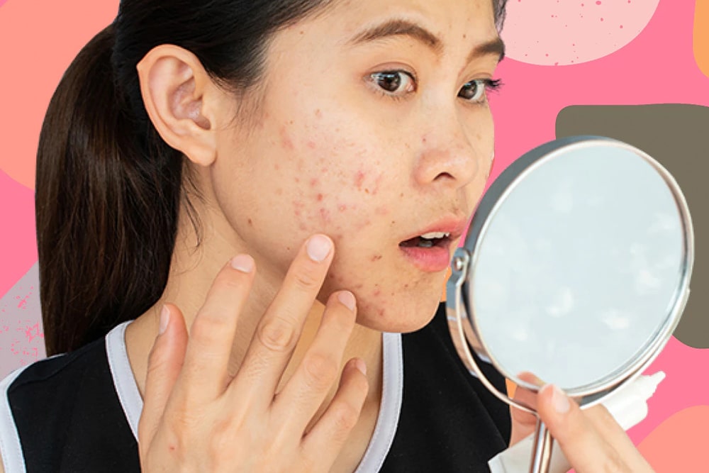 Top 6 Cleansers For Acne Prone Skin