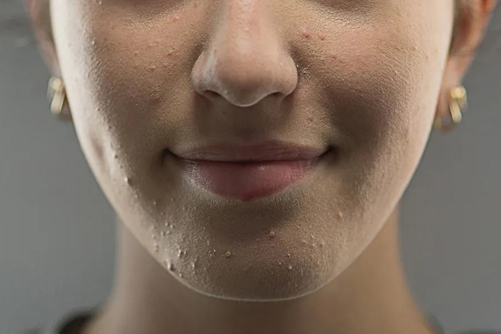 Acne Prone Skin - Tips, Care, And Products