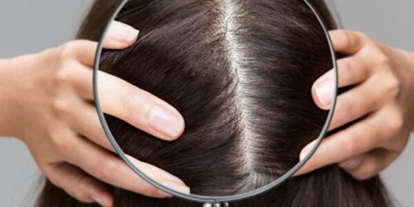 How to Get Rid of Dandruff Once and For All